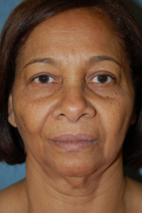 Face Lift and Neck Lift Patient 43313 Before Photo # 1