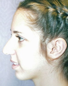 Rhinoplasty Patient 10829 Before Photo # 3