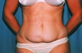 Tummy Tuck Patient 15918 Before Photo # 1