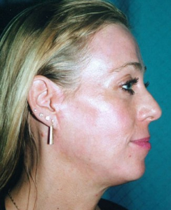 Eye Lift - Blepharoplasty Patient 37904 After Photo # 2