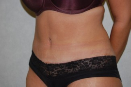 Tummy Tuck Patient 56117 After Photo # 4