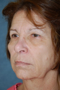 Face Lift and Neck Lift Patient 18954 Before Photo # 3