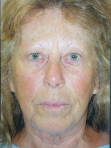 Injectables Patient 27314 Before Photo # 1