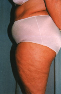 Liposuction Patient 25577 Before Photo # 5