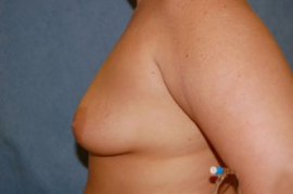 Breast Augmentation and Lift Patient 28081 Before Photo # 3