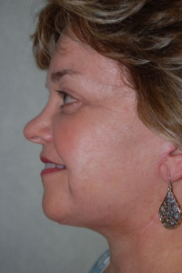 Face Lift and Neck Lift Patient 27540 After Photo # 6