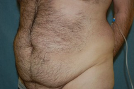 Tummy Tuck Patient 95680 Before Photo # 3