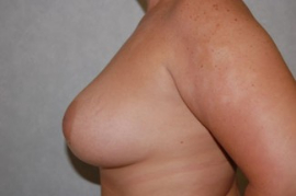 Breast Augmentation and Lift Patient 28081 After Photo # 4