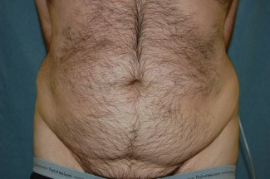 Tummy Tuck Patient 95680 Before Photo # 1