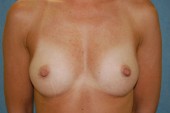 Breast Augmentation Patient 12011 Before Photo # 1