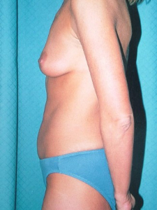Breast Enhancement and Tummy Tuck Patient 90821 Before Photo # 3