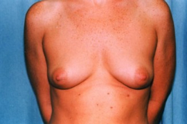 Breast Augmentation Patient 90070 Before Photo # 1