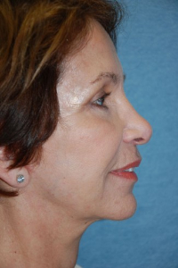 Face Lift and Neck Lift Patient 18954 After Photo # 6