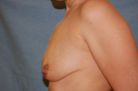 Breast Augmentation and Lift Patient 17767 Before Photo # 3