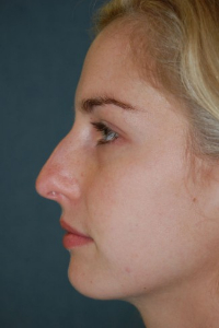 Rhinoplasty Patient 65711 Before Photo # 5