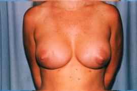 Breast Augmentation Patient 90070 After Photo # 2