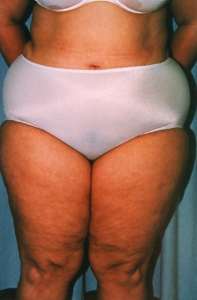 Liposuction Patient 25577 Before Photo # 1