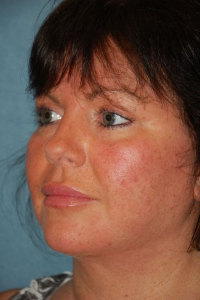 Face Lift and Neck Lift Patient 15871 After Photo # 6