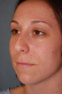 Chin Augmentation Patient 68370 Before Photo # 1