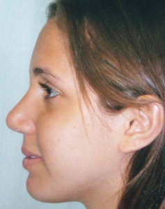 Chin Augmentation Patient 37617 After Photo # 4