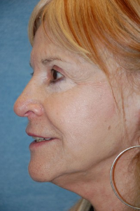 Face Lift - (greater than 80 years old) Patient 30019 After Photo # 4