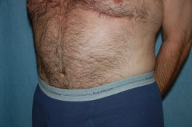 Tummy Tuck Patient 95680 After Photo # 4