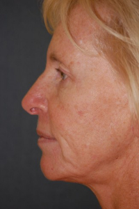 Face Lift and Neck Lift Patient 59380 Before Photo # 3