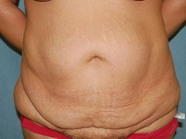 Body Lift Patient 56396 Before Photo # 1
