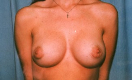 Breast Augmentation Patient 35218 After Photo # 2