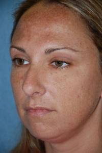 Chin Augmentation Patient 27625 Before Photo # 1