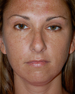 Rhinoplasty Patient 70122 Before Photo # 1