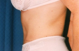 Tummy Tuck Patient 15918 After Photo # 6