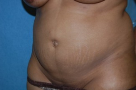 Tummy Tuck Patient 55304 Before Photo # 3