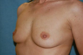 Breast Augmentation Patient 89092 Before Photo # 3