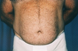 Tummy Tuck - Men Patient 44902 Before Photo # 1