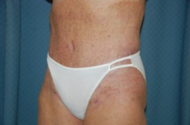 Body Lift Patient 42627 After Photo # 4