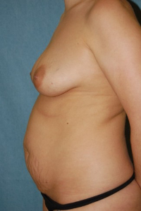Breast Enhancement and Tummy Tuck Patient 78972 Before Photo # 5