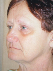 Eye Lift - Blepharoplasty Patient 14431 Before Photo # 5