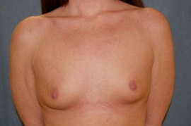 Breast Augmentation Patient 34919 Before Photo # 1