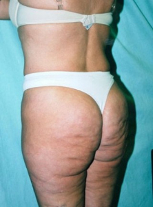 Body Lift Patient 34135 Before Photo # 3