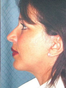 Injectables Patient 39688 After Photo # 2