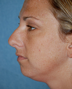 Rhinoplasty Patient 70122 Before Photo # 5