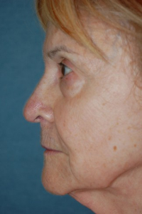 Face Lift - (greater than 80 years old) Patient 30019 Before Photo # 3