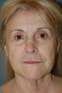 Face Lift - (greater than 80 years old) Patient 30019 Before Photo # 1