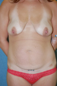 Tummy Tuck Patient 80440 Before Photo # 1
