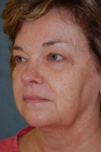 Face Lift and Neck Lift Patient 27540 Before Photo # 3