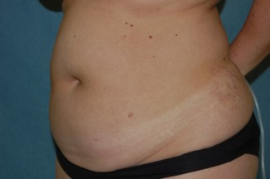 Liposuction Patient 79601 Before Photo # 3