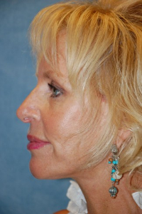 Face Lift and Neck Lift Patient 59380 After Photo # 6