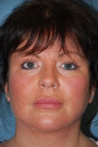 Eye Lift - Blepharoplasty Patient 60760 After Photo # 2