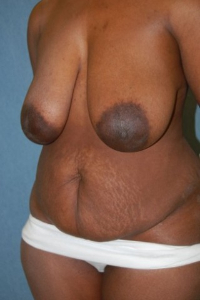 Tummy Tuck Patient 81328 Before Photo # 3